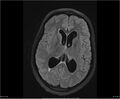 Brainstem glioma (Radiopaedia 21819-21775 Axial FLAIR 22).jpg