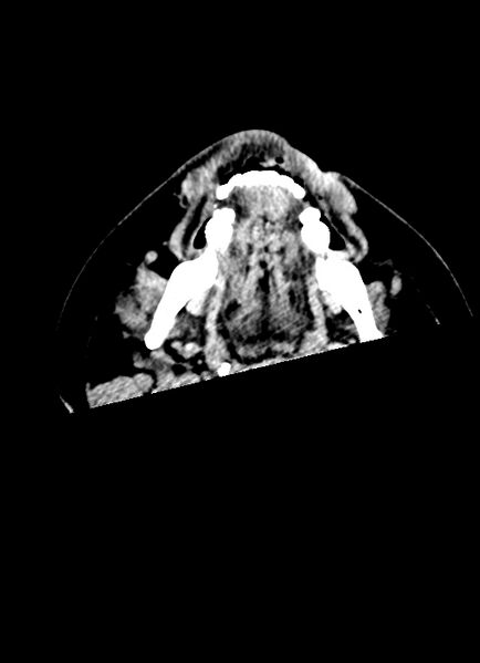 File:Brainstem hemorrhage (Radiopaedia 81294-94976 Axial non-contrast 81).jpg