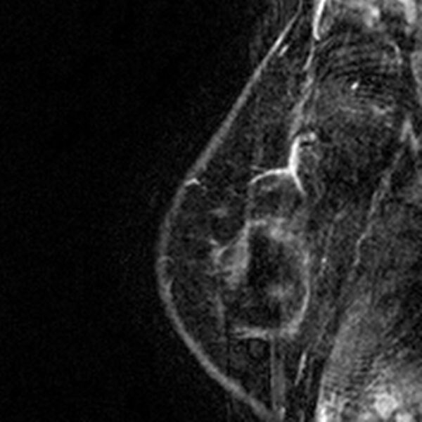 File:Breast implants - MRI (Radiopaedia 26864-27035 Sagittal T2 118).jpg
