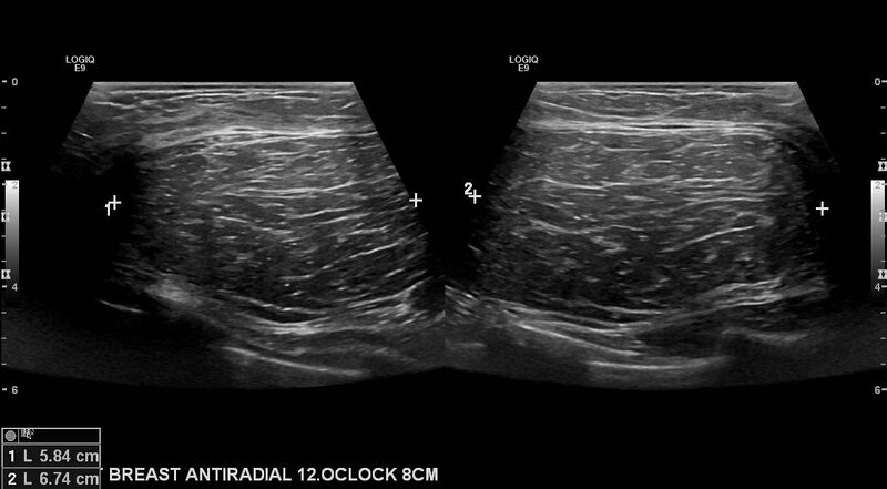 File:Breast lipoma (Radiopaedia 16321-16005 A 1).jpg