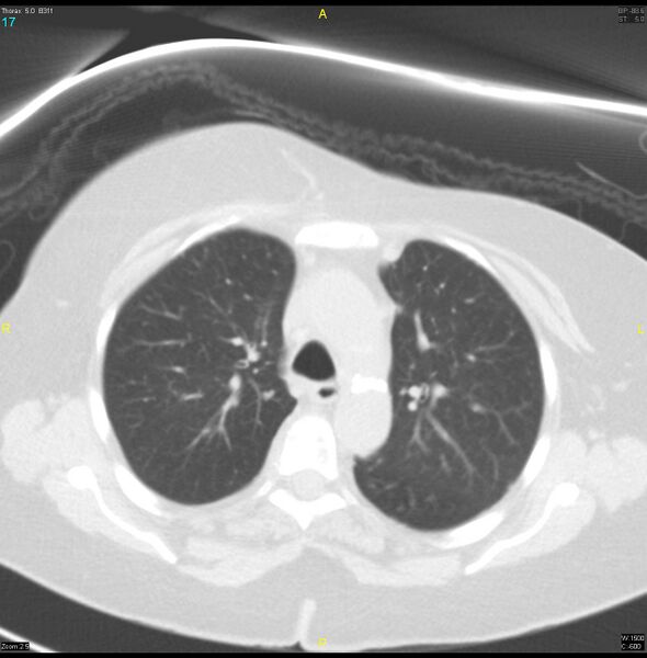 File:Breast primary with lung and bone metastases (Radiopaedia 40620-43228 Axial lung window 17).jpg