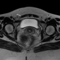 Broad ligament fibroid (Radiopaedia 49135-54241 Axial T2 22).jpg