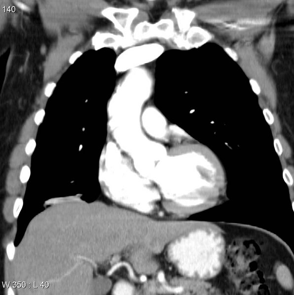 File:Bronchial carcinoid tumor with right lower lobe collapse (Radiopaedia 29060-29422 C 9).jpg