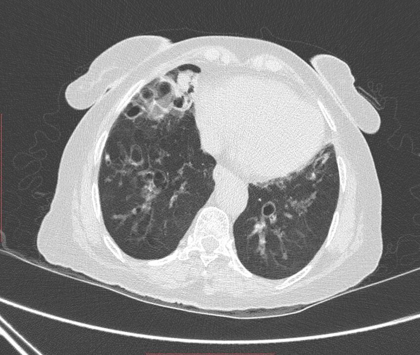 Bronchiectasis (Radiopaedia 72693-83293 Axial lung window 99).jpg