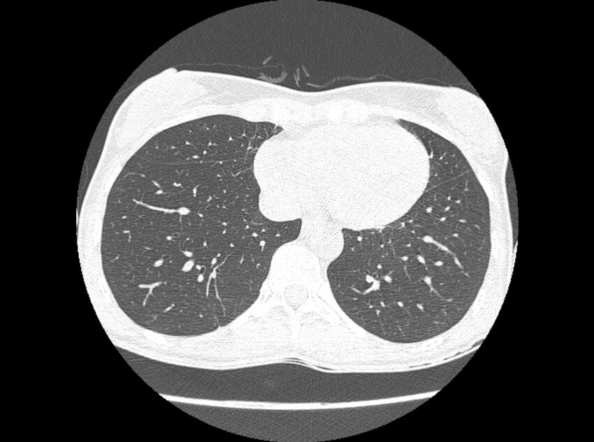 Bronchogenic cyst (Radiopaedia 80273-93615 Axial lung window 3).jpg