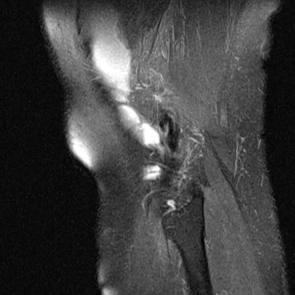 File:Bucket handle tear - medial meniscus (Radiopaedia 79028-91942 Sagittal PD fat sat 1).jpg