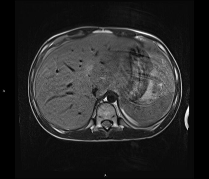 File:Burkitt lymphoma (bowel) (Radiopaedia 68839-78557 Axial T2 12).jpg