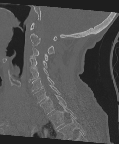File:C2 fracture with vertebral artery dissection (Radiopaedia 37378-39199 Sagittal bone window 46).png