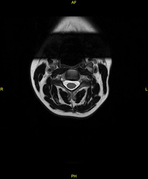File:C5 nerve sheath tumor (Radiopaedia 85777-101596 Axial T2 7).jpg