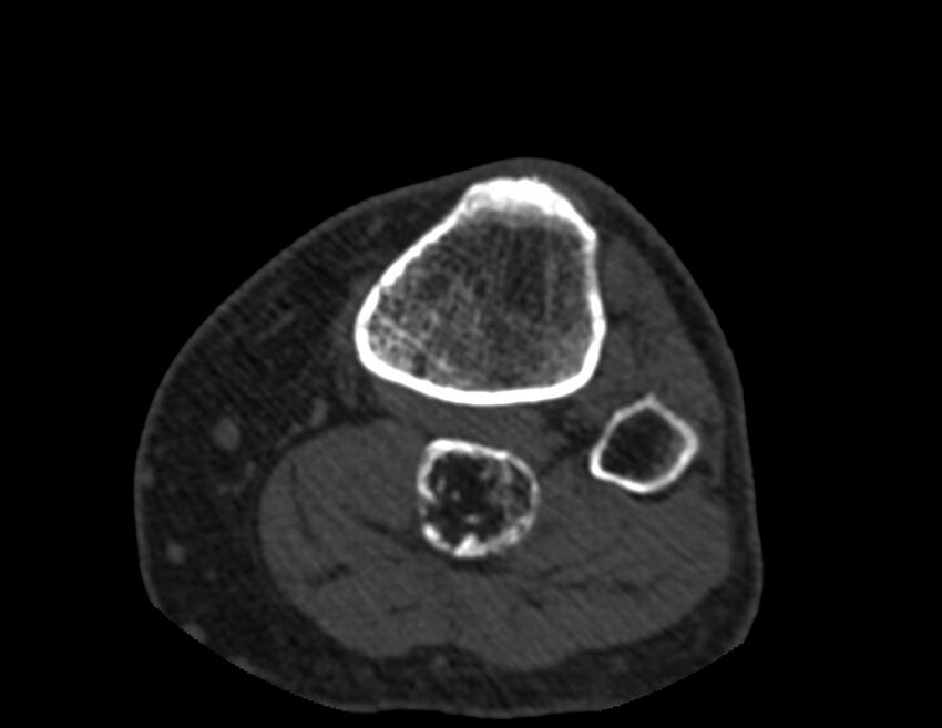 Calcified hematoma - popliteal fossa (Radiopaedia 63938-72763 Axial bone window 85).jpg