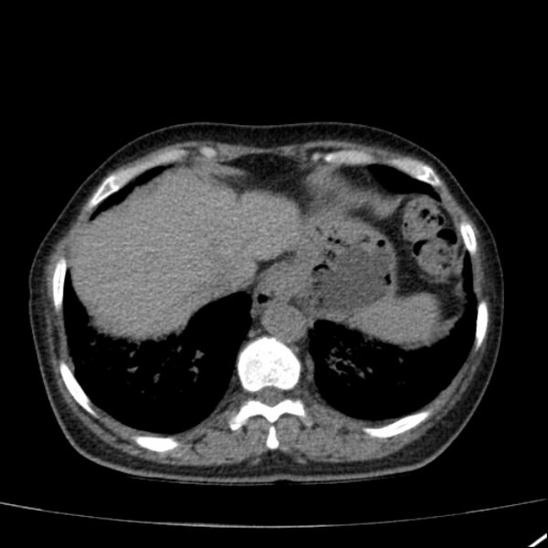 File:Calcified hepatic hydatid cyst (Radiopaedia 26872-27046 Axial non-contrast 14).jpg