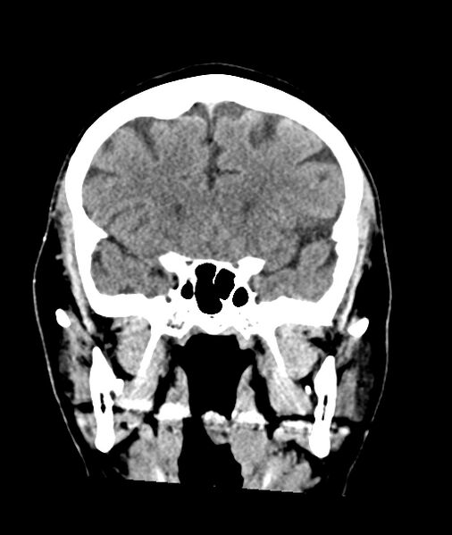 File:Calcified meningioma (Radiopaedia 74361-85243 Coronal non-contrast 17).jpg