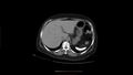 Calcified spleen (Radiopaedia 60952-68768 Axial non-contrast 4).jpg