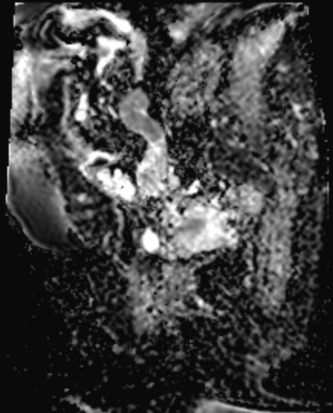 File:Cancer cervix - stage IIb (Radiopaedia 75411-86615 Sagittal ADC 5).jpg