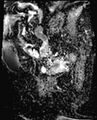 Cancer cervix - stage IIb (Radiopaedia 75411-86615 Sagittal ADC 5).jpg