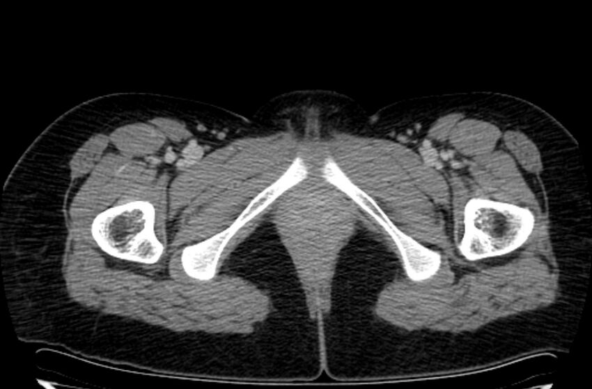 Cannonball metastases - uterine choriocarcinoma (Radiopaedia 70137-80174 A 74).jpg