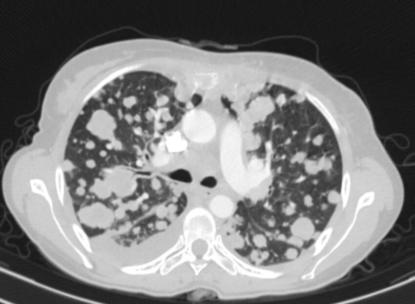 Cannonball metastases from breast cancer (Radiopaedia 91024-108569 Axial lung window 35).jpg