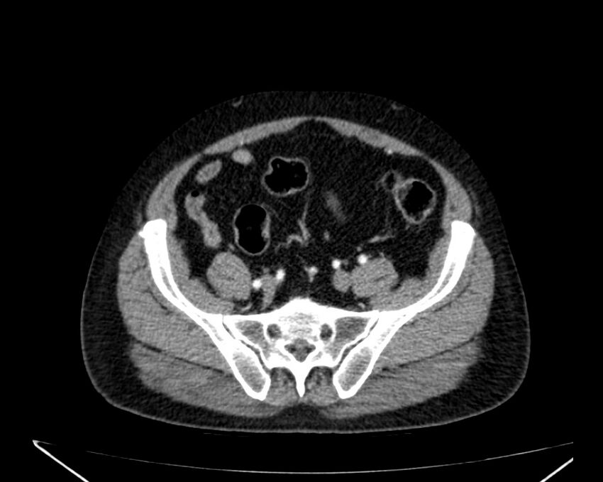 Carcinoid tumor with hepatic metastases (Radiopaedia 22651-22670 B 68).jpg