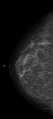 Carcinoma left breast (Radiopaedia 24885-25141 CC 1).png