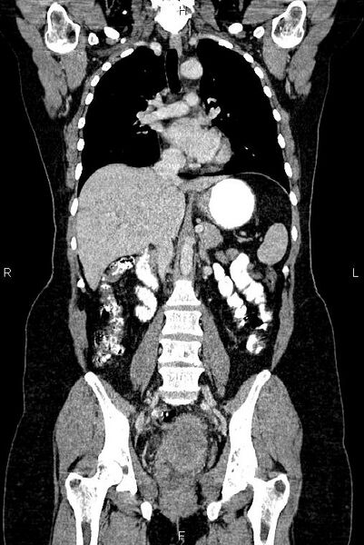 File:Carcinoma of uterine cervix (Radiopaedia 85861-101700 C 30).jpg