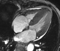 Cardiac amyloidosis (Radiopaedia 39736-42124 D 8).jpg