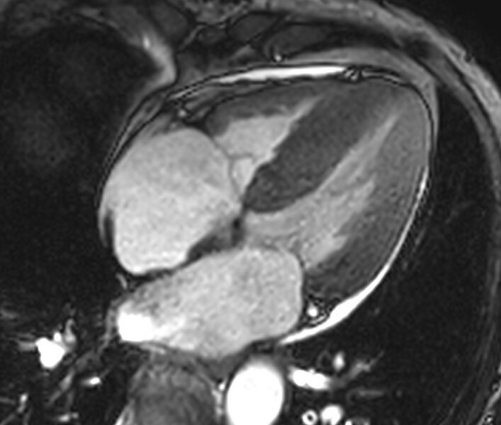 File:Cardiac amyloidosis (Radiopaedia 39736-42124 D 8).jpg