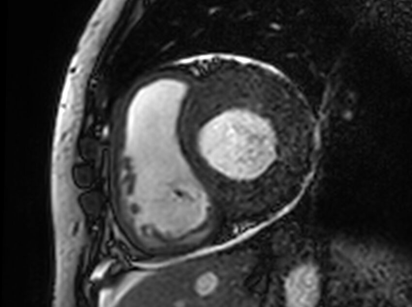 Cardiac amyloidosis (Radiopaedia 61600-69579 Short axis bSSFP 244).jpg
