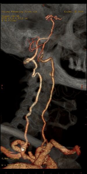 File:Carotid artery stenosis (Radiopaedia 28786-29086 B 10).jpg
