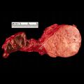 Carotid body tumor (gross pathology) (Radiopaedia 9361).jpg