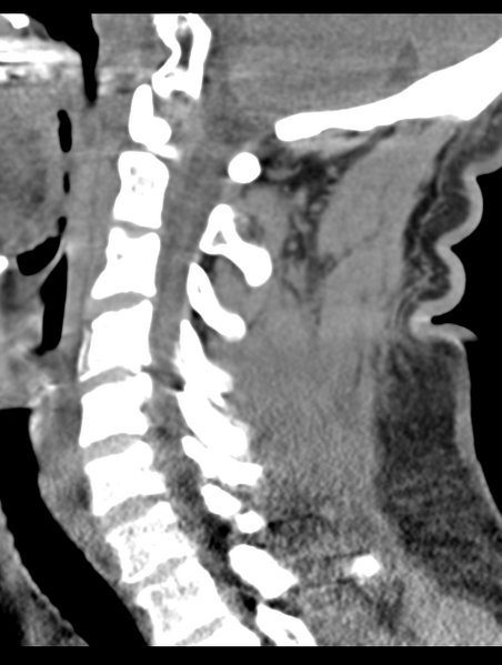 File:Cavernoma of cervical cord (Radiopaedia 50838-56346 B 46).png