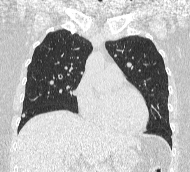 File:Cavitating pulmonary metastases (Radiopaedia 17796-17555 Coronal lung window 6).jpg