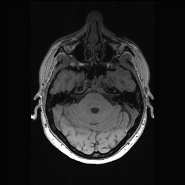 File:Central base of skull meningioma (Radiopaedia 53531-59549 Axial T1 7).jpg