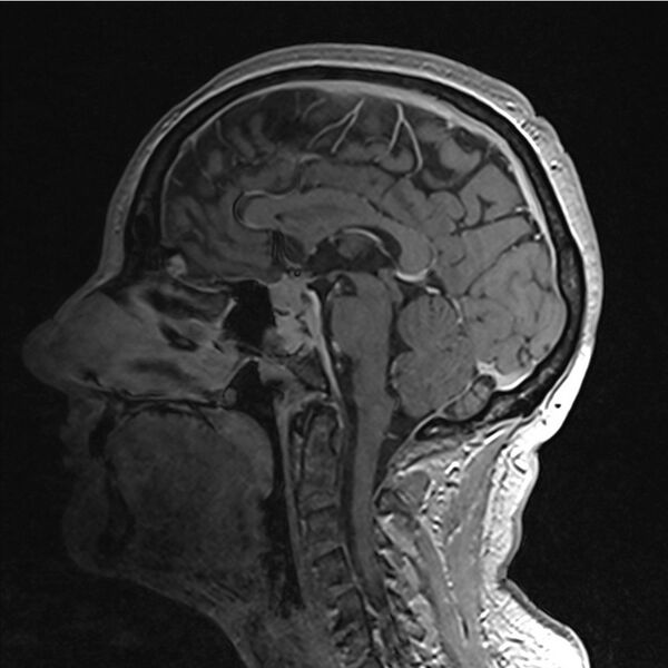File:Central base of skull meningioma (Radiopaedia 53531-59549 Sagittal T1 C+ 24).jpg