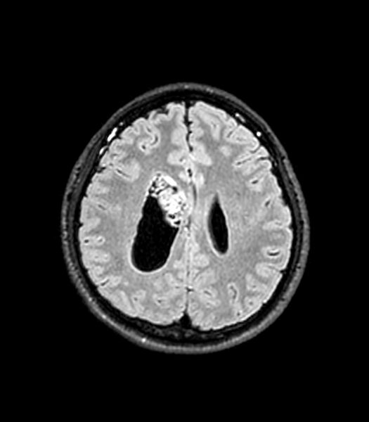 File:Central neurocytoma (Radiopaedia 79320-92380 Axial FLAIR 107).jpg