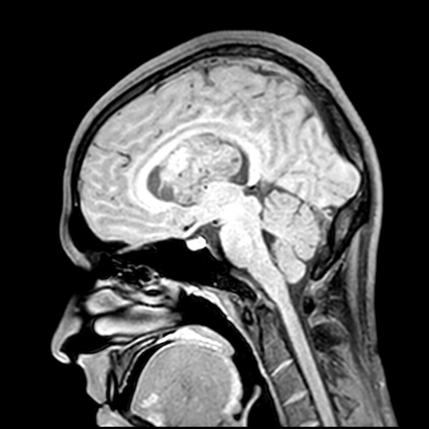 Central neurocytoma (Radiopaedia 79320-92380 Sagittal T1 137).jpg