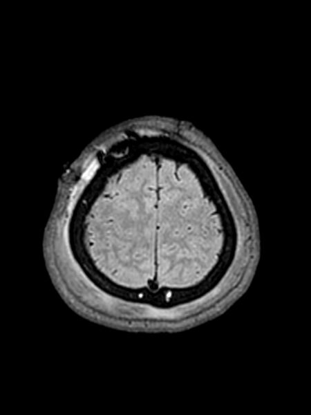 File:Central neurocytoma (Radiopaedia 79320-92381 Axial FLAIR 36).jpg