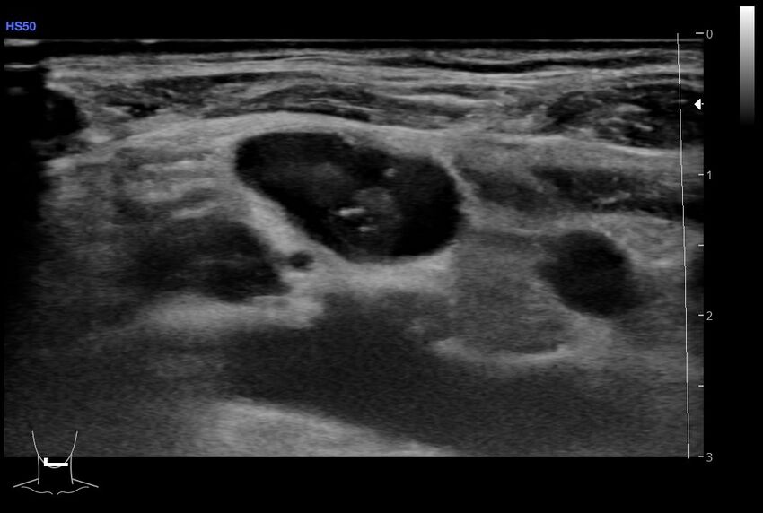 Central venous catheter-related thrombosis (Radiopaedia 61135-69025 Transverse 34).jpg