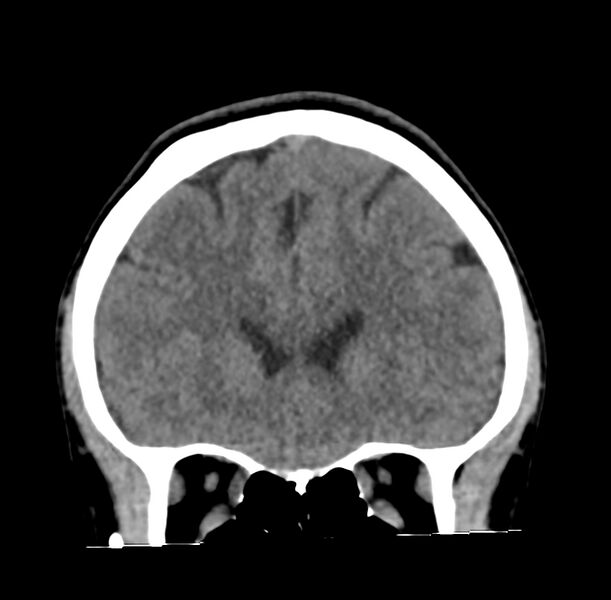 File:Cerebellar agenesis (Radiopaedia 30203-30817 Coronal non-contrast 5).jpg