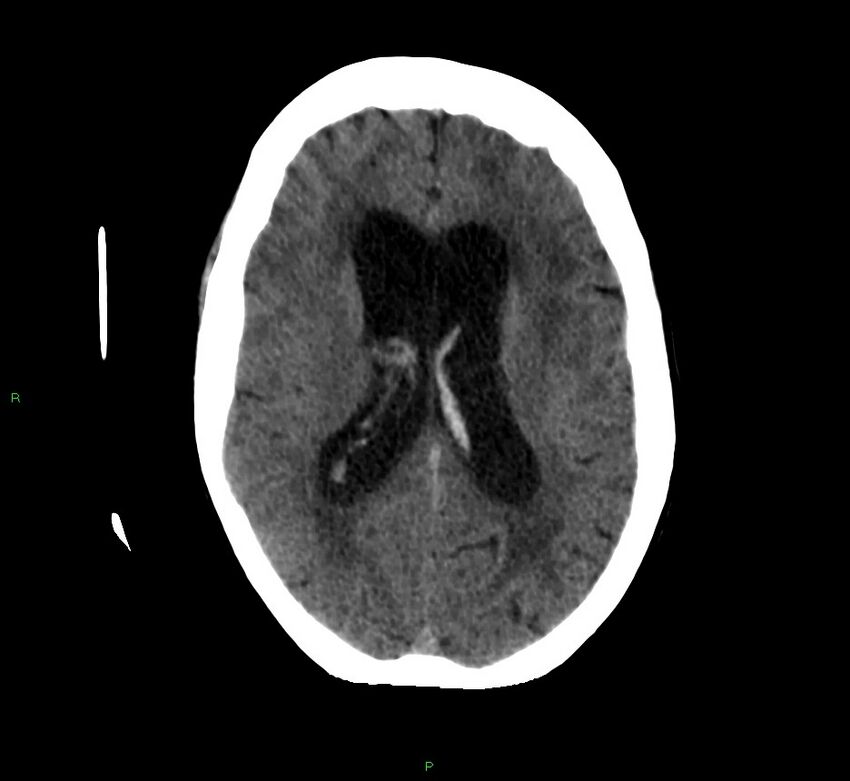 Cerebellar hemorrhage (Radiopaedia 58792-66026 Axial non-contrast 22).jpg