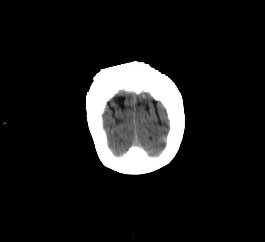 Cerebellar hemorrhage (Radiopaedia 58792-66026 Coronal non-contrast 7).jpg