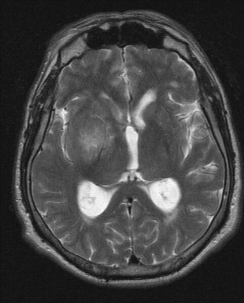 File:Cerebellopontine angle meningioma (Radiopaedia 24459-24764 Axial T2 12).jpg