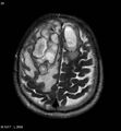 Cerebral abscesses secondary to contusions (Radiopaedia 5201-6968 Axial T2 9).jpg