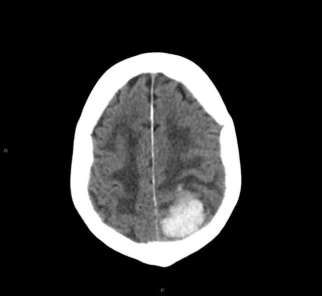 File:Cerebral amyloid angiopathy-associated lobar intracerebral hemorrhage (Radiopaedia 58530-65688 Axial non-contrast 11).jpg