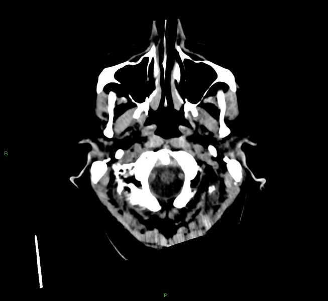 File:Cerebral amyloid angiopathy-associated lobar intracerebral hemorrhage (Radiopaedia 58560-65723 Axial non-contrast 49).jpg