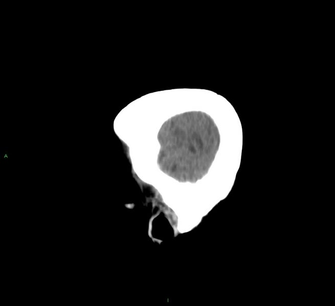 File:Cerebral amyloid angiopathy-associated lobar intracerebral hemorrhage (Radiopaedia 58751-65972 C 7).jpg