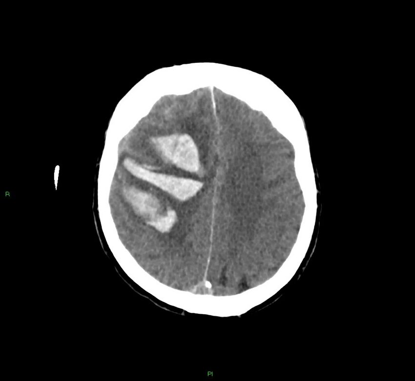 Cerebral amyloid angiopathy-associated lobar intracerebral hemorrhage (Radiopaedia 58756-65977 Axial non-contrast 18).jpg
