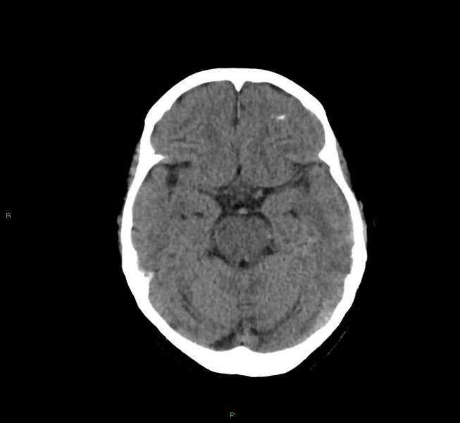 File:Cerebral amyloid angiopathy-associated lobar intracerebral hemorrhage (Radiopaedia 58757-65978 Axial non-contrast 34).jpg
