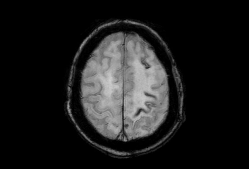 Cerebral amyloid angiopathy (Radiopaedia 86671-102792 Axial Gradient Echo 11).jpg
