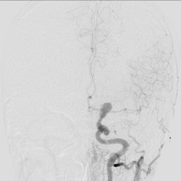 File:Cerebral aneurysm with rupture (Radiopaedia 29933-30458 LT ICA IC 15).jpg