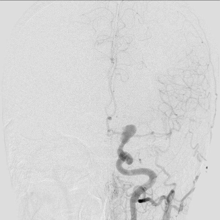 Cerebral aneurysm with rupture (Radiopaedia 29933-30458 LT ICA IC 15).jpg